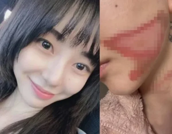 권민아 의료사고 사례로 본 미용시술 안전관리 – 피부과 시술 전 필수 체크포인트